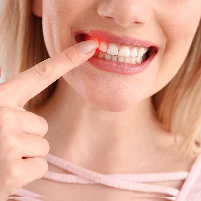 Die unsichtbare Gefahr im Mund: Alles, was Du über Parodontose bzw. Paradontits und Zahnfleischschwund wissen solltest
